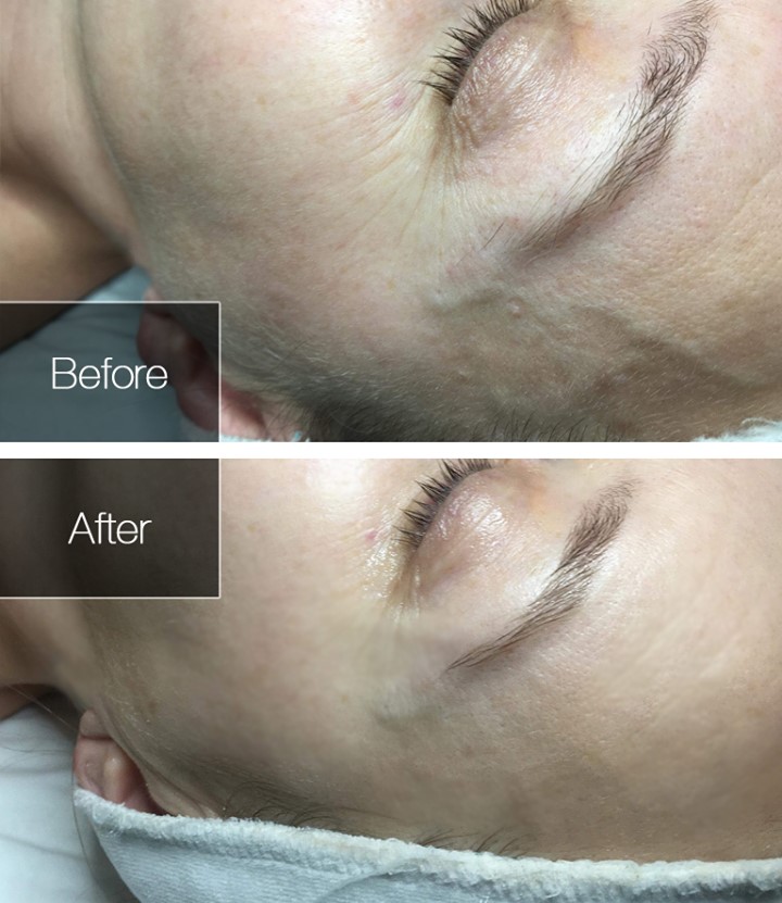 radio frequency treatment