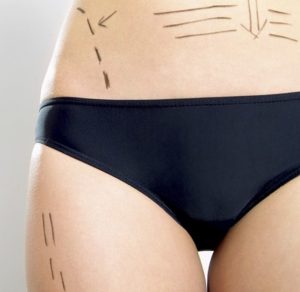ultrasound liposuction with dermamassager